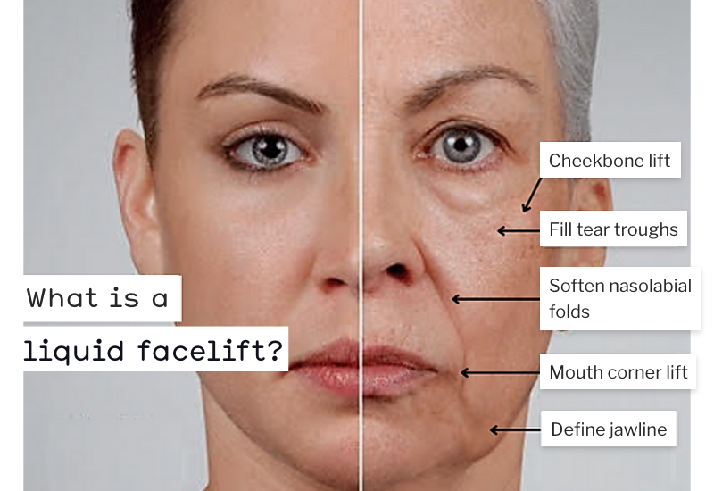 Need To Know About The Non-Invasive Liquid Facelift